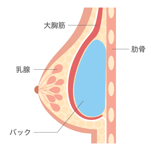 大胸筋下法