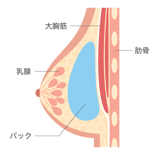 乳腺下法