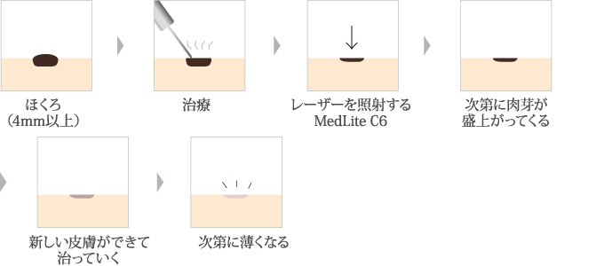 電気分解法 + レーザー治療