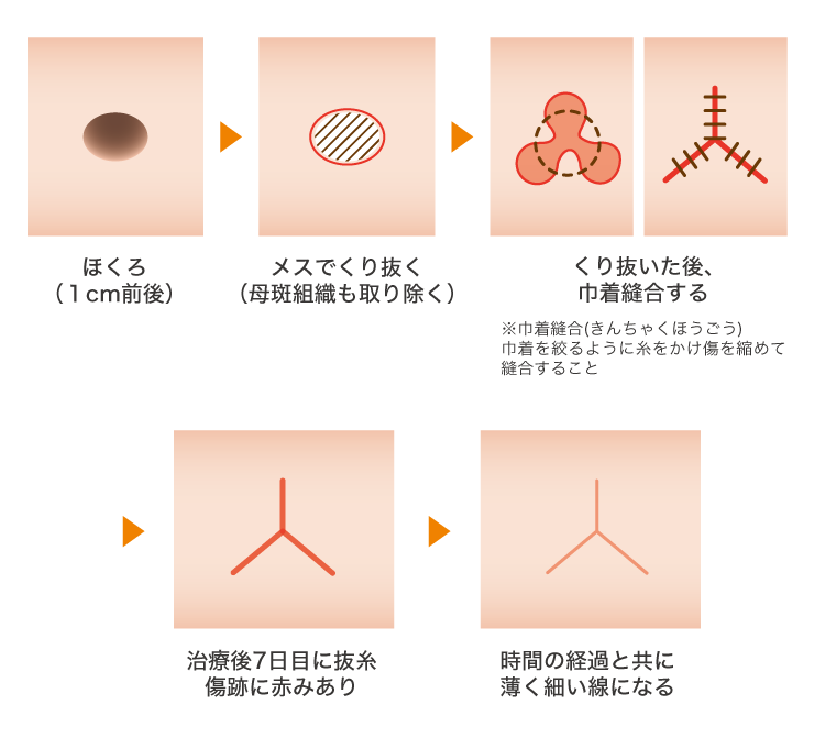 くり抜き法