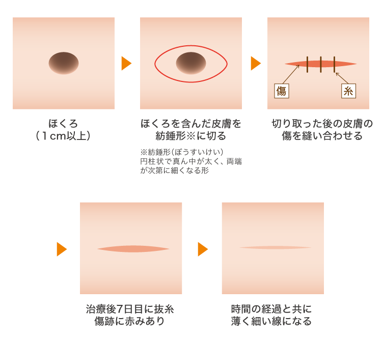 切開法