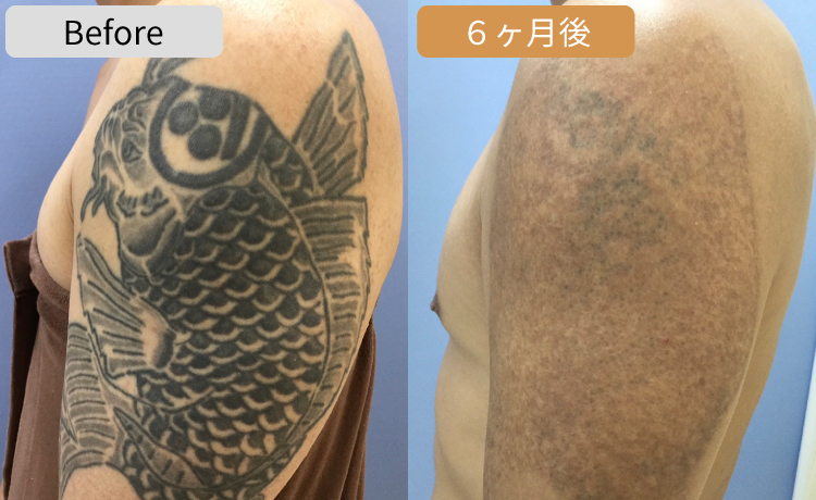 タトゥー除去ハイブリットレーザー症例