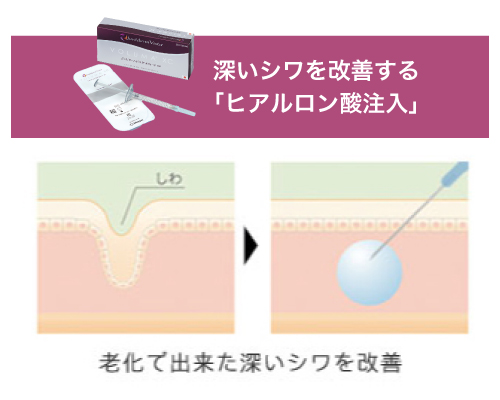 ヒアルロン酸注入